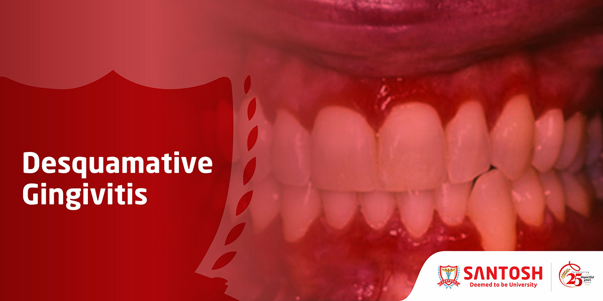 DESQUAMATIVE GINGIVITIS