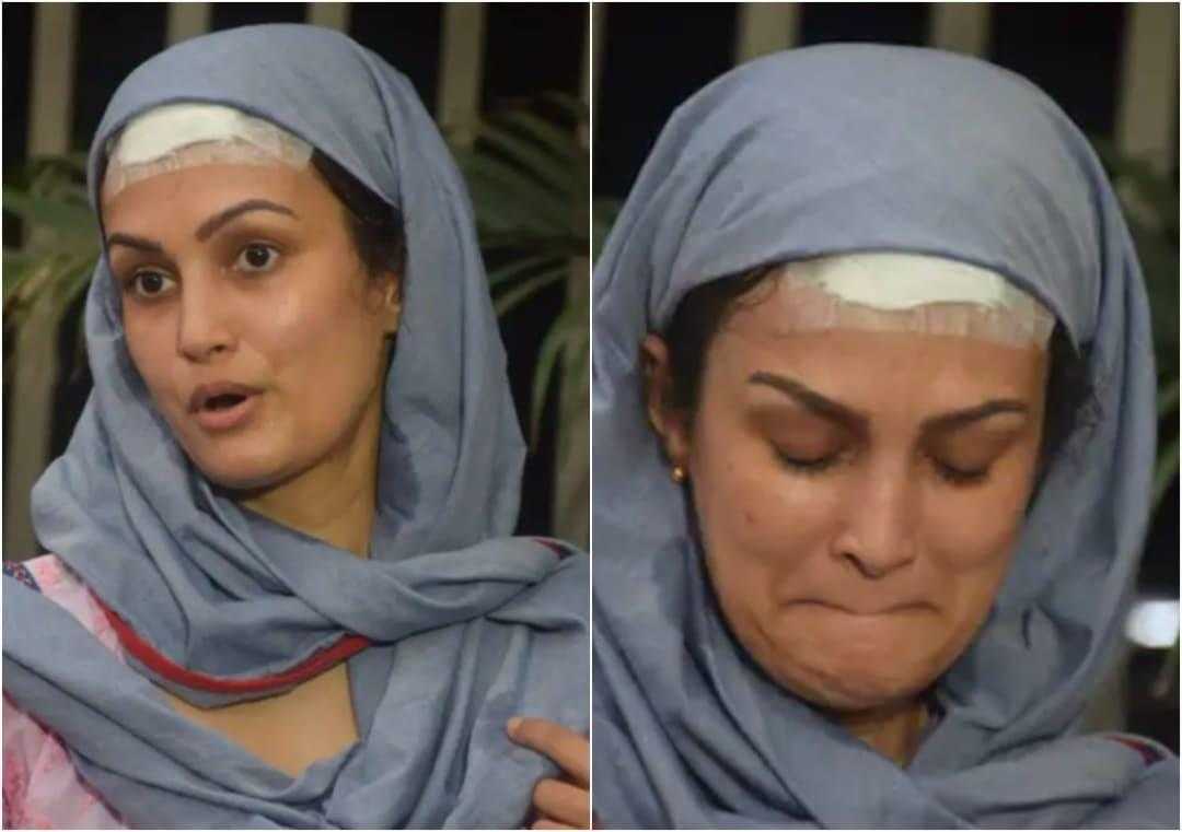 Pics show actress Nisha who accused husband Karan of assault with bandage on head