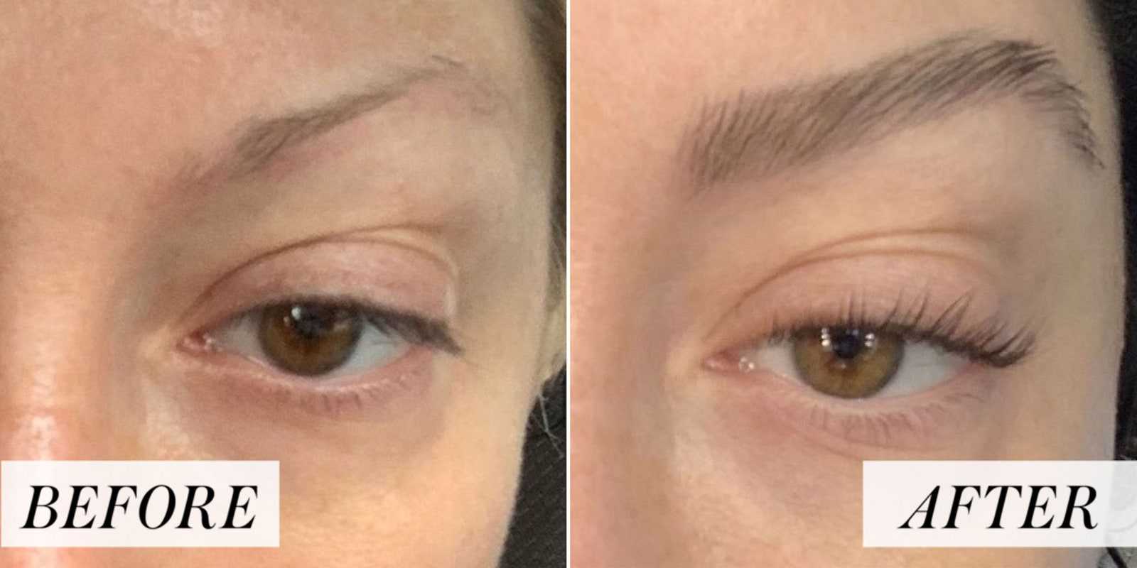 Eyebrow Restoration for Men and Women